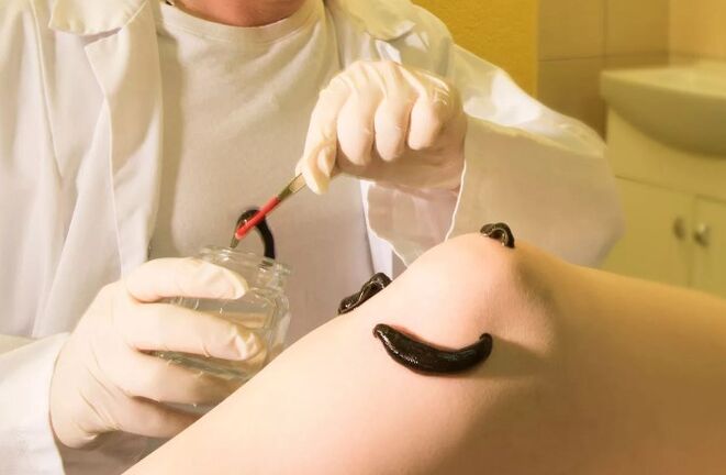 Hirudotherapy for varicose veins