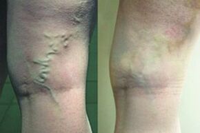 Varicose veins on the feet