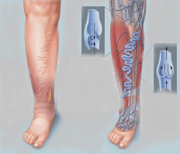 Varicose veins on the feet
