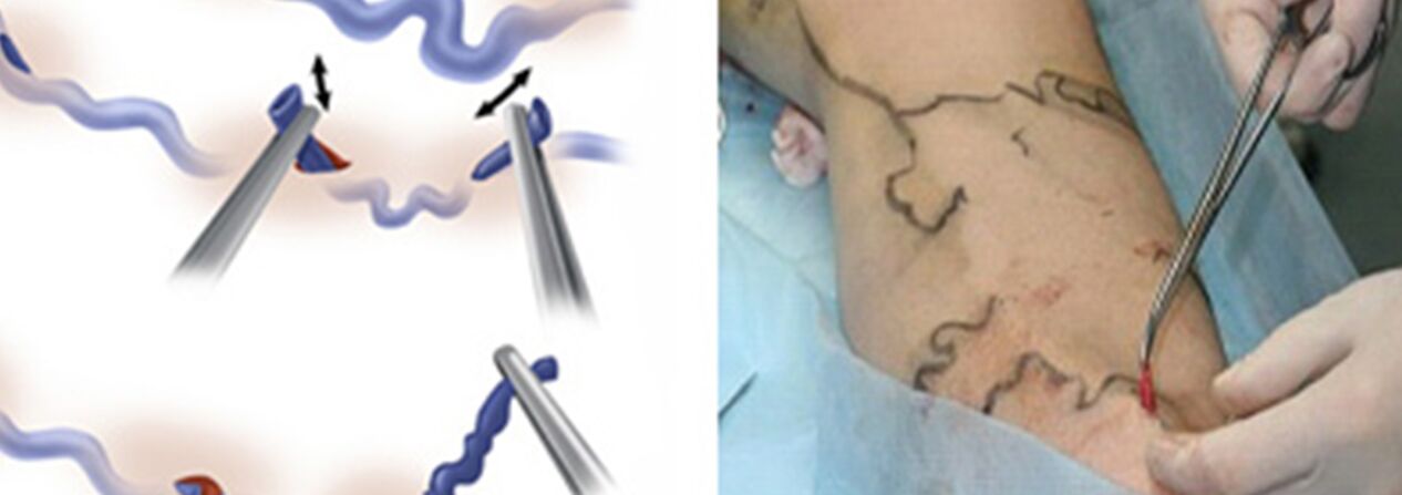 Vein surgery treatment